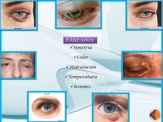 PARPADOS:
Simetría
Color

Hidratación
Temperatura
lesiones.

 