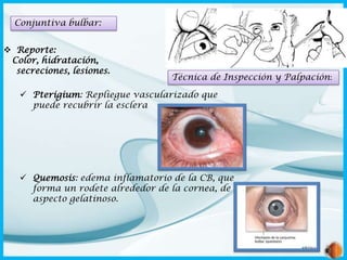 Conjuntiva bulbar:
 Reporte:
Color, hidratación,
secreciones, lesiones.

Técnica de Inspección y Palpación:

 Pterigium: Repliegue vascularizado que
puede recubrir la esclera

 Quemosis: edema inflamatorio de la CB, que
forma un rodete alrededor de la cornea, de
aspecto gelatinoso.

 