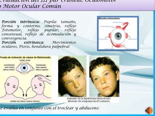 Evaluación del III par craneal: Oculomotor
o Motor Ocular Común
Porción intrínseca: Pupila: tamaño,
forma y contorno, simetría, reflejo
Fotomotor,
reflejo
pupilar,
reflejo
consensual, reflejo de acomodación y
convergencia.
Porción
extrínseca:
Movimientos
oculares, Ptosis, hendidura palpebral

Se evalúa en conjunto con el troclear y abducens:

 