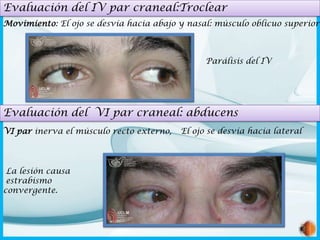 Evaluación del IV par craneal:Troclear
Movimiento: El ojo se desvía hacia abajo y nasal: músculo oblicuo superior

Parálisis del IV

Evaluación del VI par craneal: abducens
VI par inerva el músculo recto externo,

La lesión causa
estrabismo
convergente.

El ojo se desvía hacia lateral

 