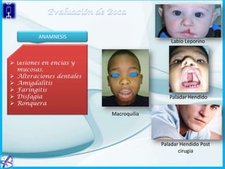 ANAMNESIS

Labio Leporino

 Lesiones en encías y
mucosas.
 Alteraciones dentales
 Amigdalitis
 Faringitis
 Disfagia
 Ronquera

Paladar Hendido
Macroquilia

Paladar Hendido Post
cirugía

 