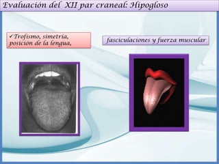 Evaluación del XII par craneal: Hipogloso

Trofismo, simetría,
posición de la lengua,

fasciculaciones y fuerza muscular

 