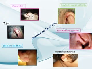 Queloides .

Condrodermatitis del hélix

Tofos
Carcinoma basocelular.

Quiste cutáneo.
Nódulos reumatoides

 