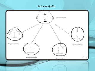 Microcefalia

 
