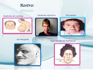 Rostro:
Síndrome de cushing

Acromegalia

Síndrome nefrotico

Mixedema

Enfermedad de Parkinson

 