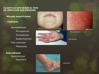 CLASIFICACION SEGÚN EL TIPO
DE INFECCION QUE PRODUCE


  Micosis superficiales

   Cutáneas

     Dermatofitosis
          Microsporum                    Tiña versicolor

          Trichophyton
          Epidermophyto             Candidiasis

     Tiña versicolor
          Malassezia


 Subcutáneas
     Esporotricosis
          Esporotrix
                              micetoma
 