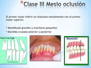 *
El primer molar inferir se relaciona mesialmente con el primer
molar superior.


• Mandíbulas grandes y maxilares pequeños
• Mordida cruzada anterior y posterior
 