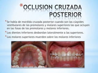 *
* Se habla de mordida cruzada posterior cuando son las cúspides
 vestibulares de los premolares y molares superiores las que ocluyen
 en las fosas de los premolares y molares inferiores.
* Los dientes inferiores desbordan lateralmente a las superiores.
* Los molares superiores muerden sobre los molares inferiores
 