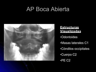 AP Boca Abierta
Estructuras
Visualizadas
•Odontoides
•Masas laterales C1
•Cóndilos occipitales
•Cuerpo C2
•PE C2
 