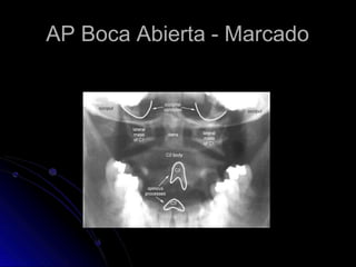 AP Boca Abierta - Marcado
 
