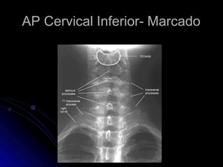 AP Cervical Inferior- Marcado
 
