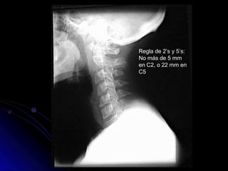 Regla de 2’s y 5’s:
No más de 5 mm
en C2, o 22 mm en
C5
 