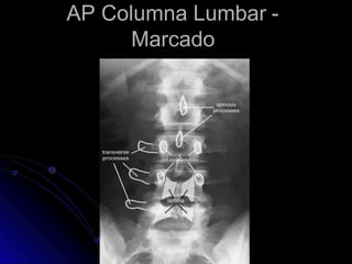 AP Columna Lumbar -
Marcado
 