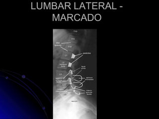 LUMBAR LATERAL -
MARCADO
 