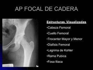 AP FOCAL DE CADERA
Estructuras Visualizadas
•Cabeza Femoral
•Cuello Femoral
•Trocanter Mayor y Menor
•Diafisis Femoral
•Lagrima de Kohler
•Rama Pubica
•Fosa Iliaca
 