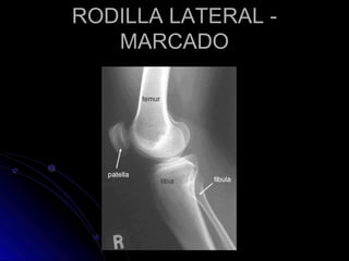 RODILLA LATERAL -
MARCADO
 