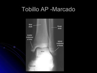 Tobillo AP -Marcado
 