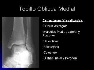 Tobillo Oblicua Medial
Estructuras Visualizadas
•Cupula Astragalo
•Maleolos Medial, Lateral y
Posterior
•Base Tibial
•Escafoides
•Calcaneo
•Diafisis Tibial y Peronea
 