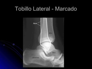 Tobillo Lateral - Marcado
 