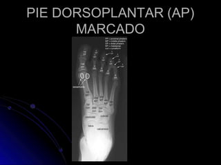 PIE DORSOPLANTAR (AP)
MARCADO
 