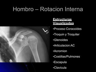 Hombro – Rotacion Interna
Estructuras
Visualizadas
•Proceso Coracoides
•Troquin y Troquiter
•Glenoides
•Articulacion AC
•Acromion
•Costillas/Pulmones
•Escapula
•Clavicula
 