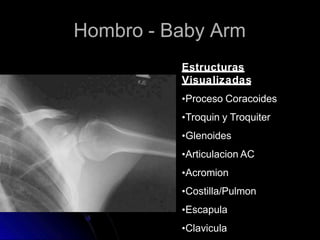 Hombro - Baby Arm
Estructuras
Visualizadas
•Proceso Coracoides
•Troquin y Troquiter
•Glenoides
•Articulacion AC
•Acromion
•Costilla/Pulmon
•Escapula
•Clavicula
 