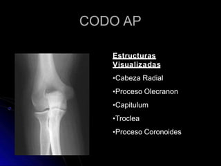 CODO AP
Estructuras
Visualizadas
•Cabeza Radial
•Proceso Olecranon
•Capitulum
•Troclea
•Proceso Coronoides
 