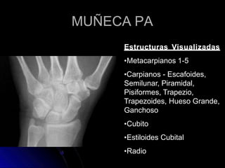 MUÑECA PA
Estructuras Visualizadas
•Metacarpianos 1-5
•Carpianos - Escafoides,
Semilunar, Piramidal,
Pisiformes, Trapezio,
Trapezoides, Hueso Grande,
Ganchoso
•Cubito
•Estiloides Cubital
•Radio
 