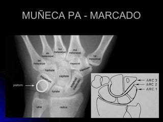 MUÑECA PA - MARCADO
 