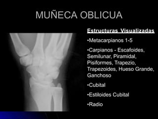 MUÑECA OBLICUA
Estructuras Visualizadas
•Metacarpianos 1-5
•Carpianos - Escafoides,
Semilunar, Piramidal,
Pisiformes, Trapezio,
Trapezoides, Hueso Grande,
Ganchoso
•Cubital
•Estiloides Cubital
•Radio
 