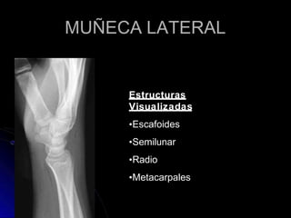 MUÑECA LATERAL
Estructuras
Visualizadas
•Escafoides
•Semilunar
•Radio
•Metacarpales
 