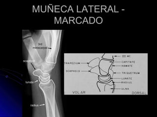 MUÑECA LATERAL -
MARCADO
 