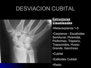 DESVIACION CUBITAL
Estructuras
Visualizadas
•Metacarpianos 1-5
•Carpianos - Escafoides
Semilunar, Piramidal,
Pisiformes, Trapezio,
Trapezoides, Hueso
Grande, Ganchoso
•Cubital
•Estiloides Cubital
•Radio
 