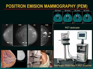 2D 4min 3D 4min 2D 2min 3D 2min
POSITRON EMISION MAMMOGRAPHY (PEM)
RX PEMPEMRX
PET dedicado
Naviscan: PEM Flex™ PET Scanner
 