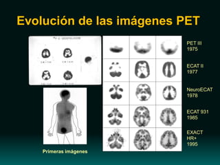 Evolución de las imágenes PET
PET III
1975
ECAT II
1977
EXACT
HR+
1995
NeuroECAT
1978
ECAT 931
1985
Primeras imágenes
 