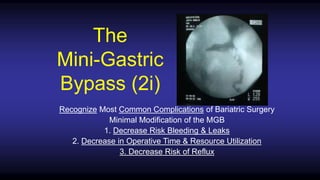 The
Mini-Gastric
Bypass (2i)
Recognize Most Common Complications of Bariatric Surgery
Minimal Modification of the MGB
1. Decrease Risk Bleeding & Leaks
2. Decrease in Operative Time & Resource Utilization
3. Decrease Risk of Reflux
 