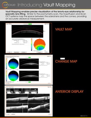 Introducing Vault Mapping
Vault Mapping enables precise visualization of the lens-to-eye relationship for
specialty lens fitting. Similar to the pachymetry scan, the iVue/iFusion and iScan
OCT systems map the space between the scleral lens and the cornea, providing
an accurate clearance measurement.
300-51317 A
CHANGE MAP
Evaluate clearance change
resulting from lens settling
between scans.
ANTERIOR DISPLAY
Evaluate superior, temporal,
inferior and nasal landing
zones.
VAULT MAP
Visualize and quantify
central corneal clearance.
1
 