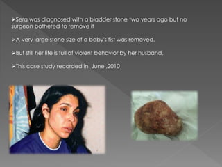 Sera was diagnosed with a bladder stone two years ago but no
surgeon bothered to remove it
A very large stone size of a baby's fist was removed.
But still her life is full of violent behavior by her husband.
This case study recorded in June ,2010
 