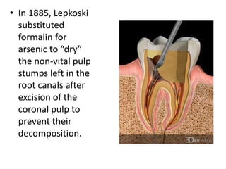 • In 1885, Lepkoski
substituted
formalin for
arsenic to “dry”
the non-vital pulp
stumps left in the
root canals after
excision of the
coronal pulp to
prevent their
decomposition.
 