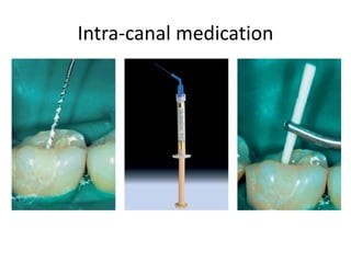 Intra-canal medication
 