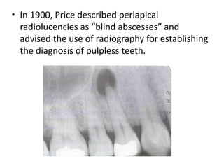 • In 1900, Price described periapical
radiolucencies as “blind abscesses” and
advised the use of radiography for establishing
the diagnosis of pulpless teeth.
 