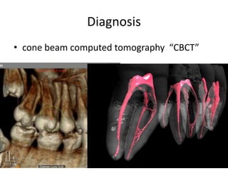 Diagnosis
• cone beam computed tomography “CBCT”
 