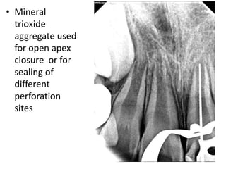• Mineral
trioxide
aggregate used
for open apex
closure or for
sealing of
different
perforation
sites
 
