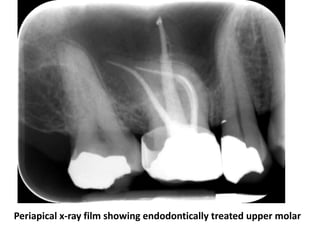 Periapical x-ray film showing endodontically treated upper molar
 