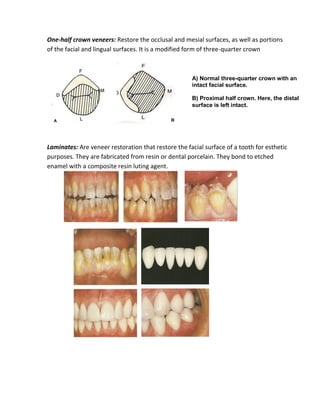 One-half crown veneers: Restore the occlusal and mesial surfaces, as well as portions
of the facial and lingual surfaces. It is a modified form of three-quarter crown
Laminates: Are veneer restoration that restore the facial surface of a tooth for esthetic
purposes. They are fabricated from resin or dental porcelain. They bond to etched
enamel with a composite resin luting agent.
A) Normal three-quarter crown with an
intact facial surface.
B) Proximal half crown. Here, the distal
surface is left intact.
 
