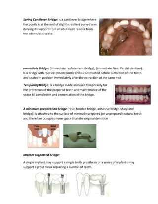 Spring Cantilever Bridge: Is a cantilever bridge where
the pontic is at the end of slightly resilient curved arm
derving its support from an abutment remote from
the edentulous space
Immediate Bridge: (Immediate replacement Bridge), (Immediate Fixed Partial denture).
Is a bridge with root extension pontic and is constructed before extraction of the tooth
and seated in position immediately after the extraction at the same visit
Temporary Bridge: Is a bridge made and used temporarily for
the protection of the prepared teeth and maintenance of the
space till completion and cementation of the bridge.
A minimum-preparation bridge (resin bonded bridge, adhesive bridge, Maryland
bridge): Is attached to the surface of minimally prepared (or unprepared) natural teeth
and therefore occupies more space than the original dentition
Implant supported bridge:
A single implant may support a single tooth prosthesis or a series of implants may
support a prost hesis replacing a number of teeth.
 