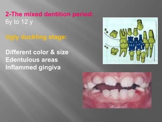 2-The mixed dentition period:
6y to 12 y
Ugly duckling stage:
Different color & size
Edentulous areas
Inflammed gingiva
 