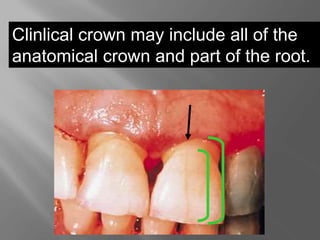 Clinlical crown may include all of the
anatomical crown and part of the root.
 