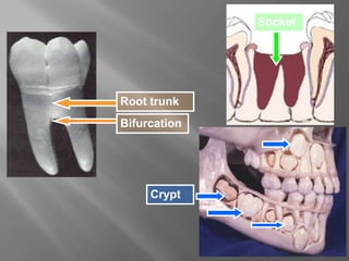 Root trunk
Bifurcation
Socket
Crypt
 