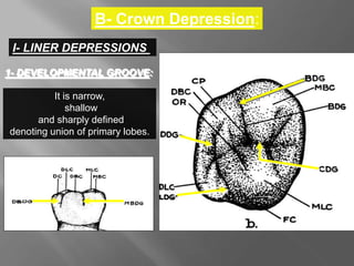 B- Crown Depression:
I- LINER DEPRESSIONS
1- DEVELOPMENTAL GROOVE:
It is narrow,
shallow
and sharply defined
denoting union of primary lobes.
 